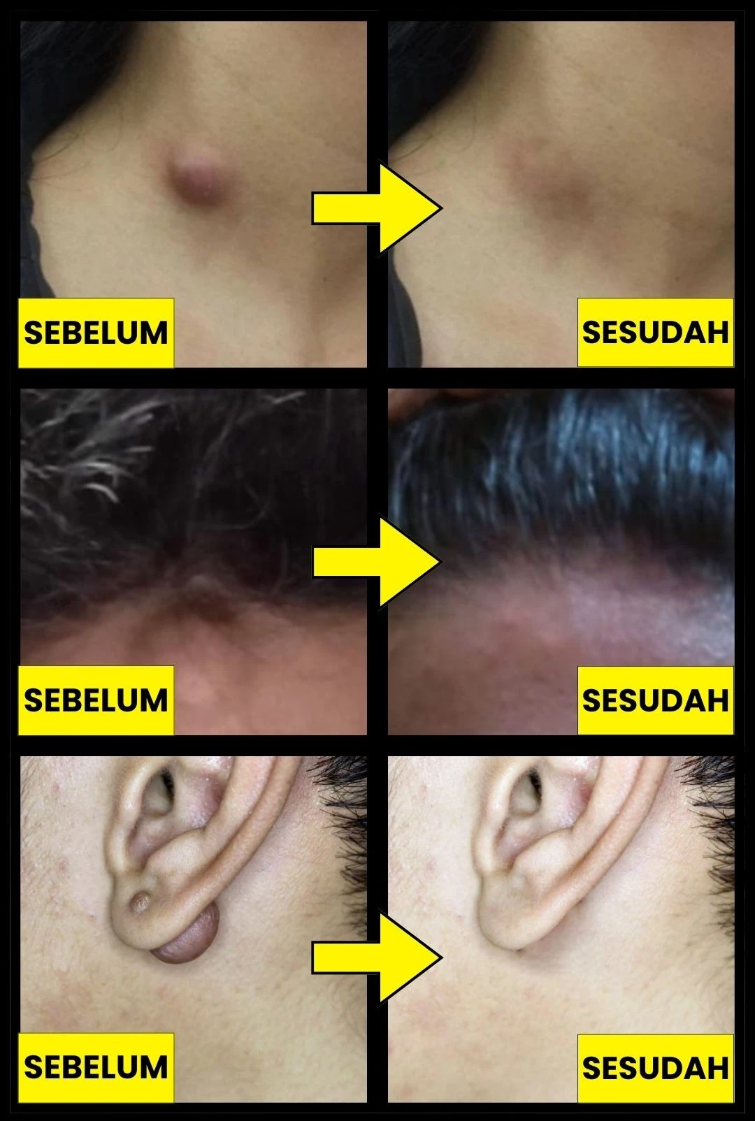 SEMBUH BENJOLAN DENGAN CEPAT